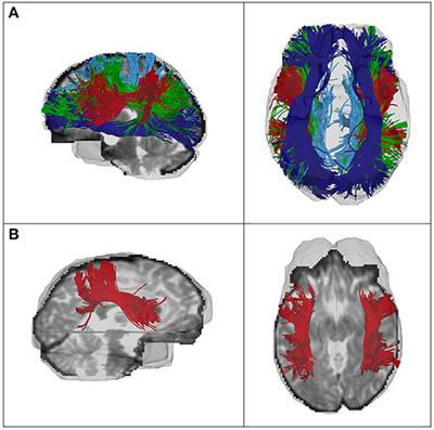 Sex-Related Differences in White Matter Asymmetry and Its Implications for Verbal Working Memory in Psychosis High-Risk State